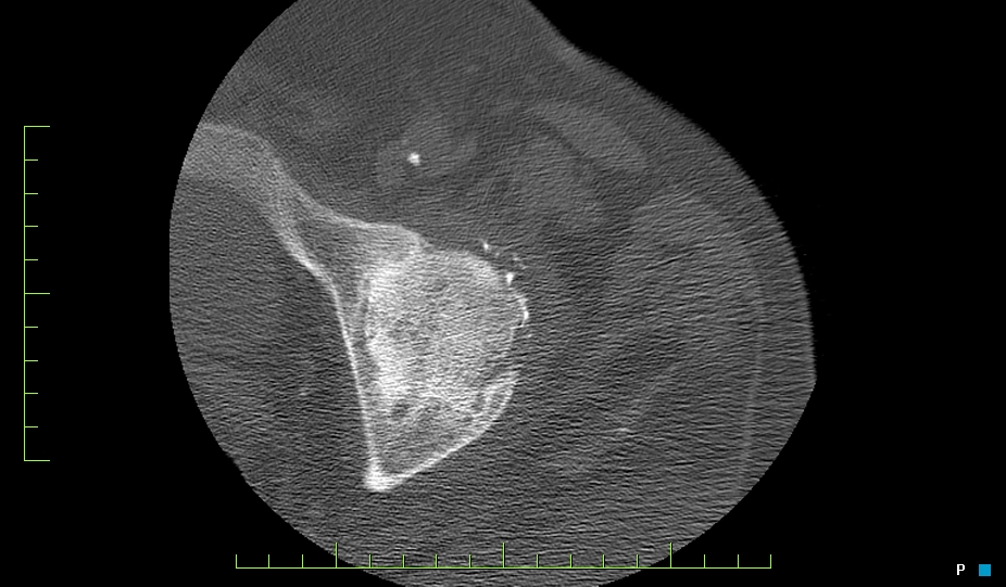 Figure 3 for case transfemoral artery steroid injection L hip